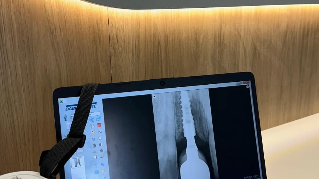 Radiografia de um implante já integrado, na tela do equipamento da Clínica Oral Sorriso